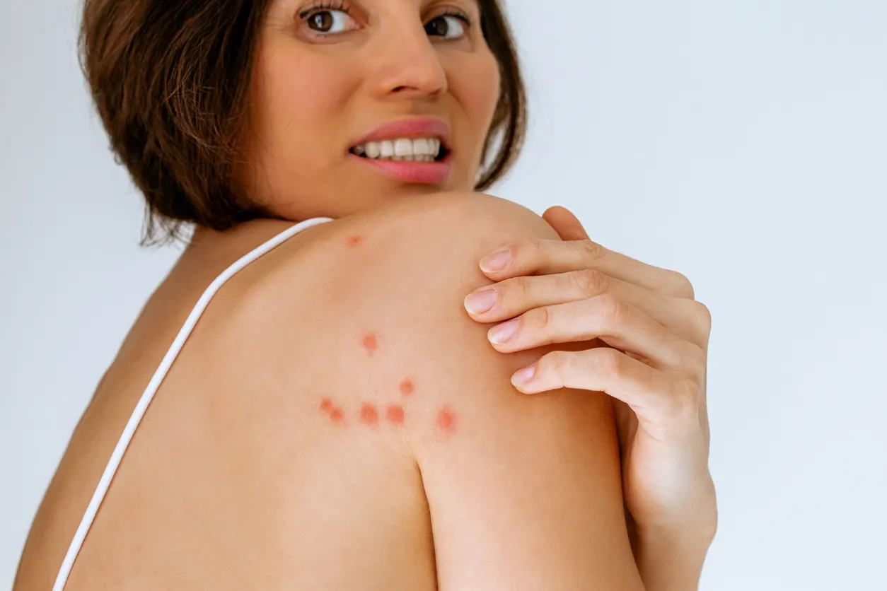 Punture da cimici da letto