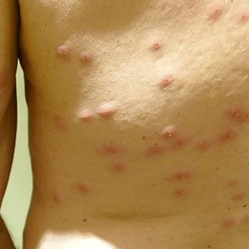 Reazione cutanea da acaro del tarlo